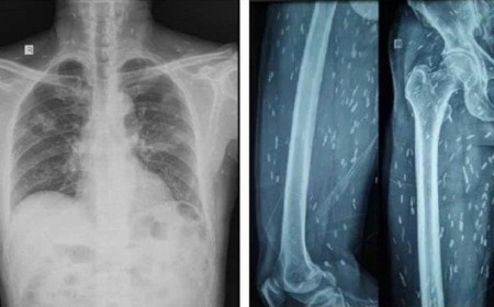 Sán làm tổ chi chít khắp cơ thể vì món khoái khẩu nhiều người Việt 'nghiện'