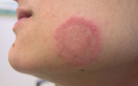 CHÀM ĐỒNG TIỀN LÀ GÌ ? CÁCH PHÒNG NGỪA VÀ ĐIỀU TRỊ