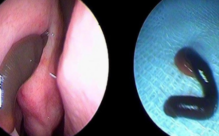 PHÁT HIỆN CON VẮT TRONG HỐC MŨI CÔ GÁI