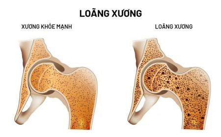 5 Điều Mọi Người Nên Biết Về Bệnh Loãng Xương