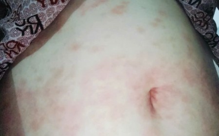 Sán lá gan lớn Fasciola tại Việt Nam: Triệu chứng, xét nghiệm và cách điều trị hiệu quả