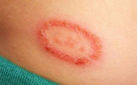 CHÀM ĐỒNG TIỀN VÀ NHỮNG ĐIỀU BẠN CHƯA BIẾT