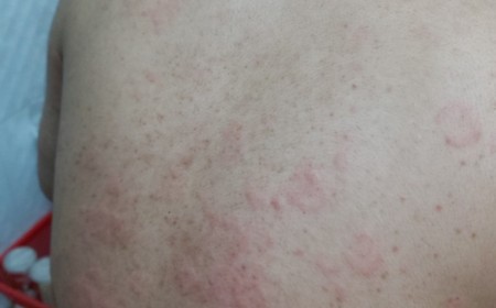 NHIỄM SÁN CHÓ DO THÓI QUEN ĂN GỎI