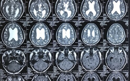 SÁN TRONG NÃO GÂY RA CÁC TRIỆU CHỨNG NHƯ TÂM THẦN