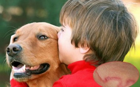 THANH NIÊN 19 TUỔI CHẾT VÌ BỆNH SÁN CHÓ
