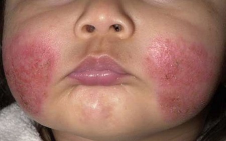 Phát Ban Ở Trẻ Em