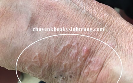 ẤU TRÙNG SÁN CHÓ DI CHUYỂN QUA DA GÂY NGỨA