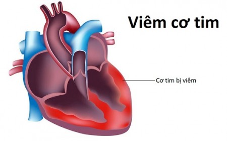 BIỂU HIỆN , NGUYÊN NHÂN VIÊM CƠ TIM SIÊU VI Ở TRẺ EM