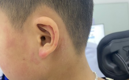 Bé Trai 9 Tuổi Nhiễm 2 Loại Ký Sinh Trùng Vì Một Thói Quen