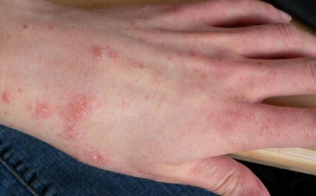 Bệnh Ghẻ: Nguyên Nhân, Triệu Chứng và Cách Điều Trị Bệnh Ghẻ
