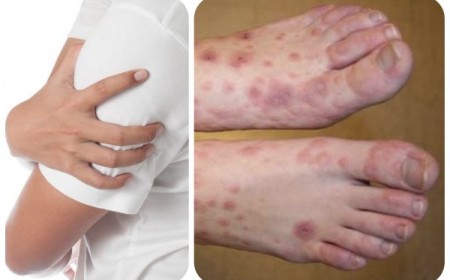 BỆNH GIUN CHỈ BẠCH HUYẾT