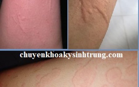 BỆNH MÀY ĐAY 