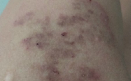 Bệnh Giun Lươn Strongyloides Lây Nhiễm Như Thế Nào?