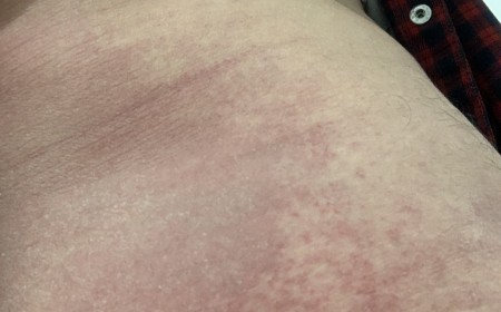 Bệnh Sán Dây Chó Echinococcus: Nguyên Nhân, Chẩn Đoán Và Cách Điều Trị