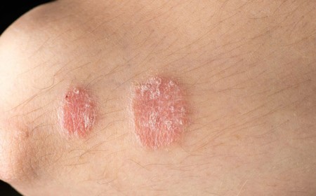 4 BỆNH VỀ DA KHI THỜI TIẾT CHUYỂN MÙA