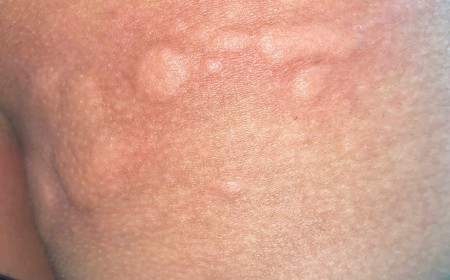 Bệnh Nhân Hỏi – Bác Sĩ Tư Vấn: Ấu Trùng Giun Sán Có Gây Ngứa Mề Đay Không?