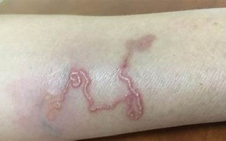 Bệnh Nhiễm Ấu Trùng Giun Lươn (Strongyloides stercoralis). Hiểm Họa Tiềm Ẩn Cần Được Phát Hiện và Đi