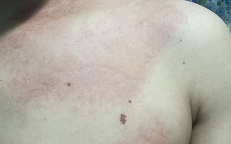 Bệnh Sán Chó Mèo Toxocara: Nguyên Nhân, Triệu Chứng Và Điều Trị