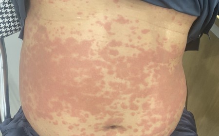 HÀ NỘI – PHÁT BAN MẨN ĐỎ KHẮP NGƯỜI, ĐI KHÁM PHÁT HIỆN NHIỄM KÝ SINH TRÙNG