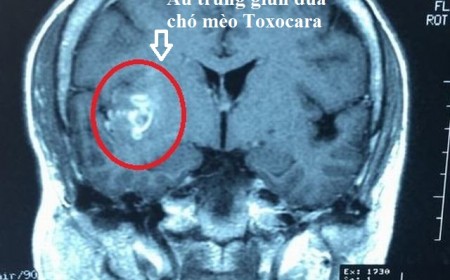 Bị Ngứa Da, Nổi Mề Đay, Dị Ứng Lâu Ngày Cần Làm Xét Nghiệm Gì Tìm Nguyên Nhân?