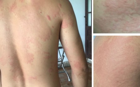 Bị Ngứa Da Nổi Mề Đay Kéo Dài Có Phải Do Nhiễm Bệnh Giun Sán?