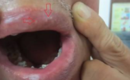 Bị Ngứa Gãi Sưng Môi Sưng Mắt Kéo Dài Có Phải Do Nhiễm Giun Sán Không?