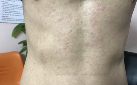 Cách Nhận Biết Nổi Mẩn Đỏ Ngứa Do Nhiễm Giun Sán