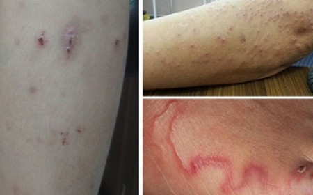 Cách phát hiện sớm bệnh sán chó và phương pháp điều trị