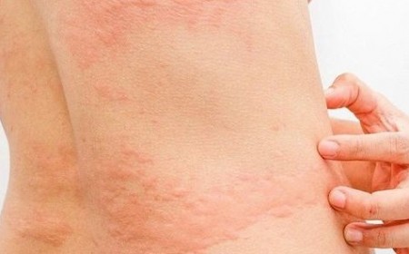 BỆNH SÁN CHÓ CÓ LÂY NHIỄM 
