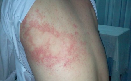 Câu hỏi tư vấn về bệnh ngứa da lâu ngày và cách chữa trị
