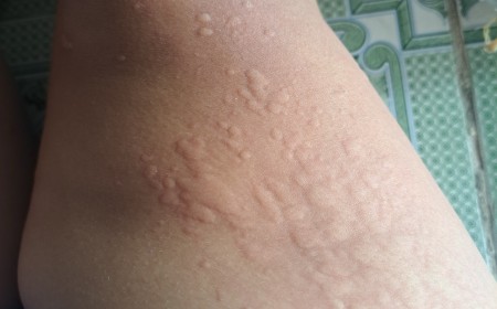 Chỉ Số Bạch Cầu Ái Toan Tăng Cao Có Phải Nhiễm Ký Sinh Trùng Không?