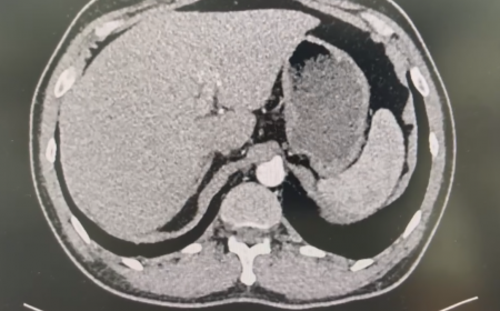 Chụp MRI Có U Ở Gan, Nghi Có Sán Lá Gan