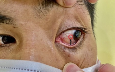 Dấu Hiệu Nào Cảnh Báo Mắt Nhìn Mờ Do Nhiễm Ký Sinh Trùng Giun Sán