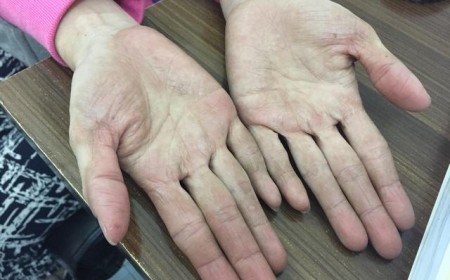 Dấu hiệu nào nhận biết viêm da cơ địa do nhiễm giun sán?