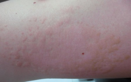 Dị Ứng Ngứa Chàm Dị Ứng Gây Ngứa Da Do Nhiễm Giun Sán 