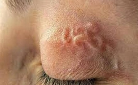 Điều Trị Giun Lươn Strongyloides Biến Chứng Nặng Theo Phác Đồ 15 Ngày