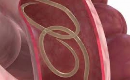 Chẩn Đoán Và Điều Trị Bệnh Giun Xoắn