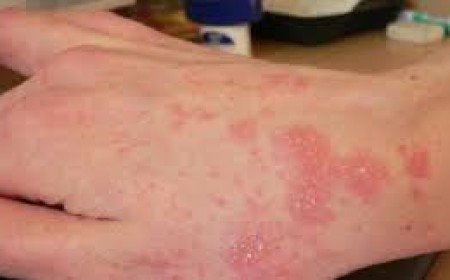 Một Số Tác Hại Của Bệnh Nấm Nông Cần Phải Biết