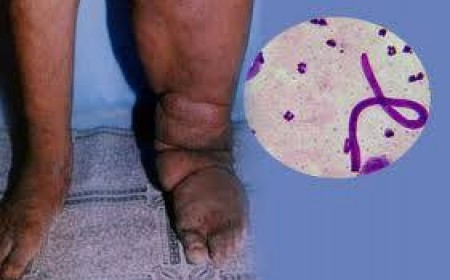 Nguyên Nhân Và Tác Hại Của Bệnh Giun Chỉ Bạch Huyết