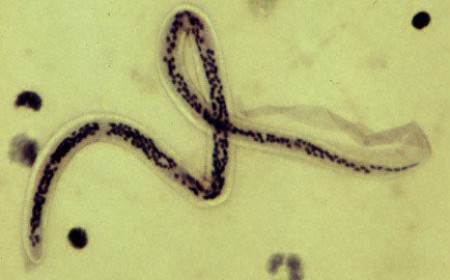 Triệu Chứng Của Bệnh Giun Chỉ Thường Gặp