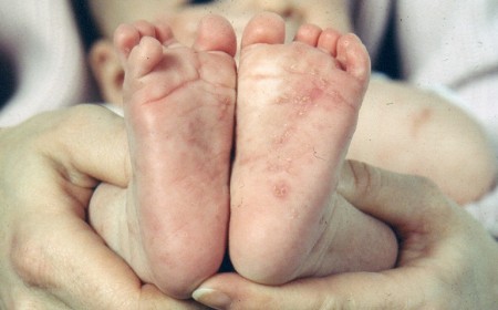 PHÒNG BỆNH KÝ SINH TRÙNG CHO TRẺ