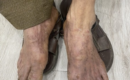 Giun lươn: Con Đường Lây Nhiễm, Triệu Chứng Và Cách Điều Trị