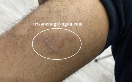 Bệnh Giun Móc Ancylostoma: Nguyên Nhân Lây Nhiễm, Triệu Chứng Và Cách Điều Trị Hiệu Quả
