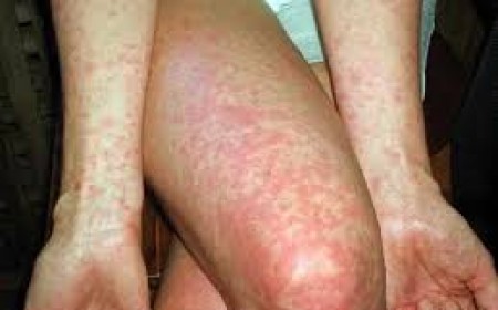 Điều Trị Bệnh Sán Chó Uy Tín Nhất Ở Đâu