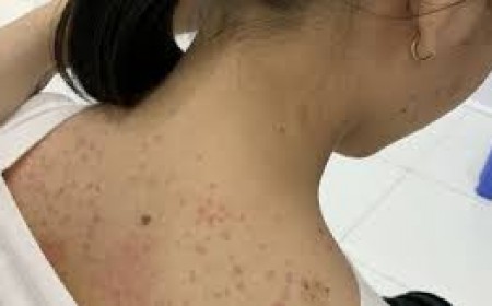 Triệu chứng sán chó ở người