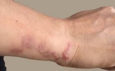 Chẩn Đoán Và Phòng Ngừa Bệnh Sán Dây Lợn