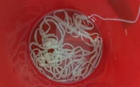 Chẩn Đoán Và Điều Trị Sán Xơ Mít