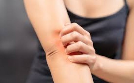 Ngứa Da Dị Ứng Do Nhiễm Ký Sinh Trùng