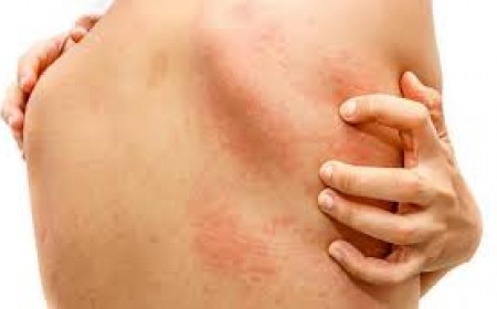 Điều trị nổi mề đay do nhiễm ký sinh trùng