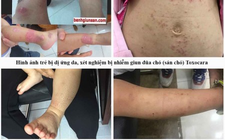 Khi Trẻ Bị Dị Ứng Da Cần Làm Xét Nghiệm Gì Tìm Nguyên Nhân Dị Ứng Da